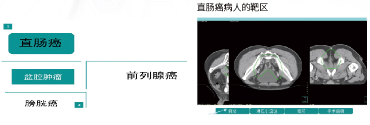 俯卧位盆腔定位垫